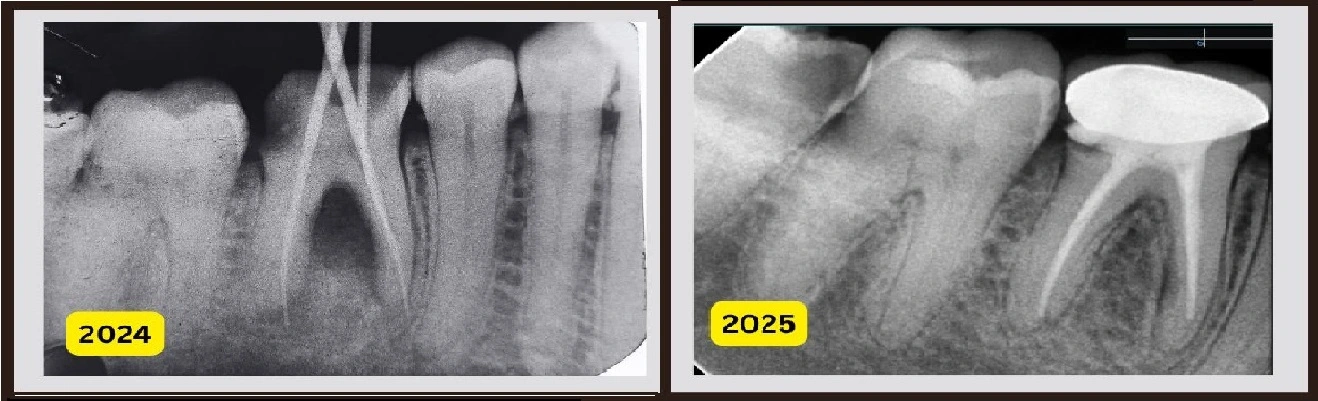 teeth cleaning